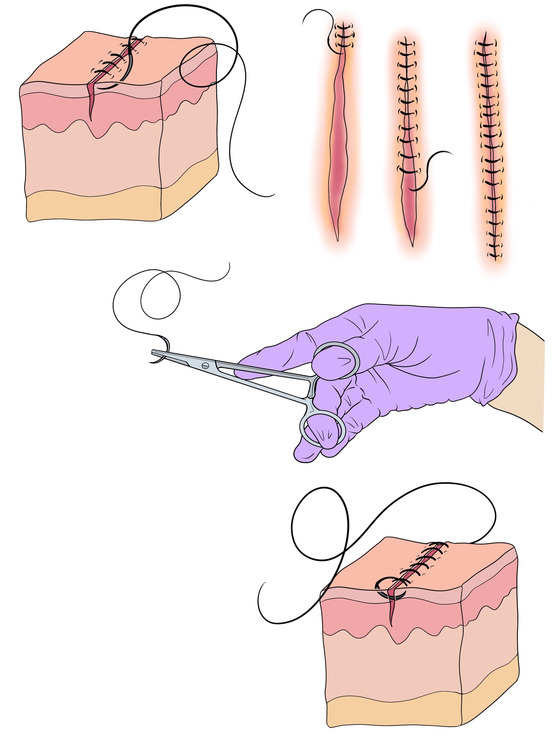 11)_Continuous_Suture_
